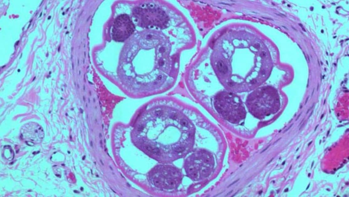 angiostrongylus-costaricensis