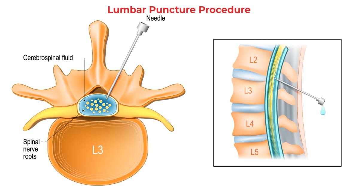 lumbar-puncture-procedure