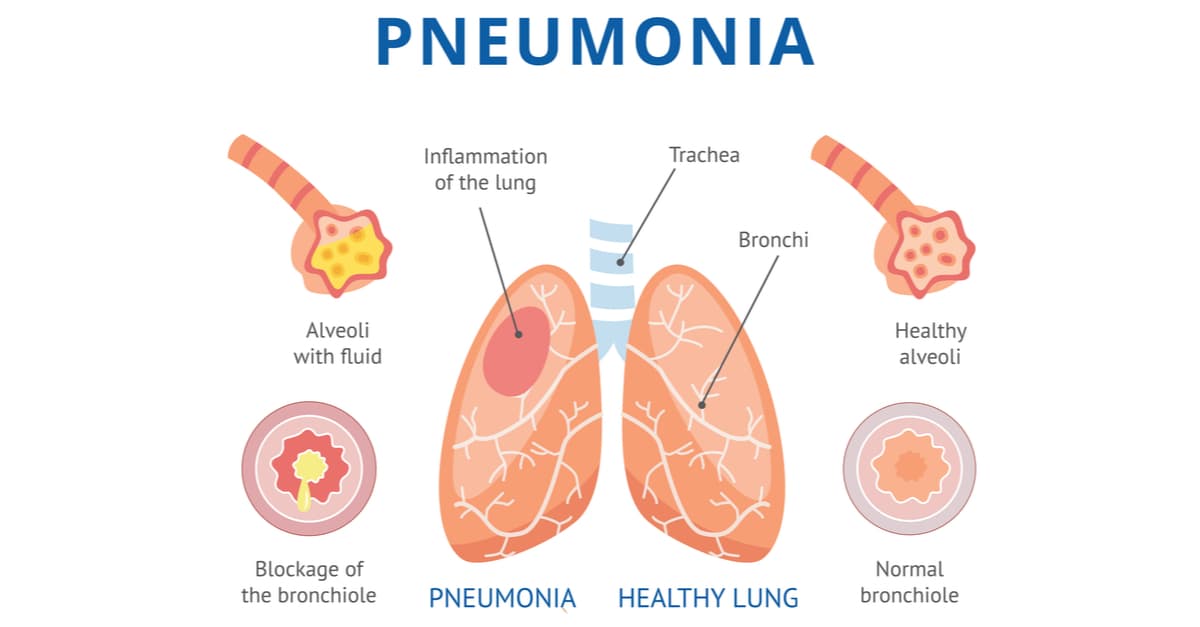 pneumonia
