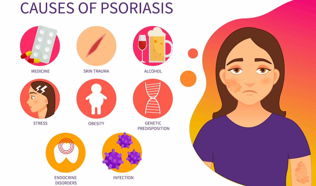 causes-of-psoriasis
