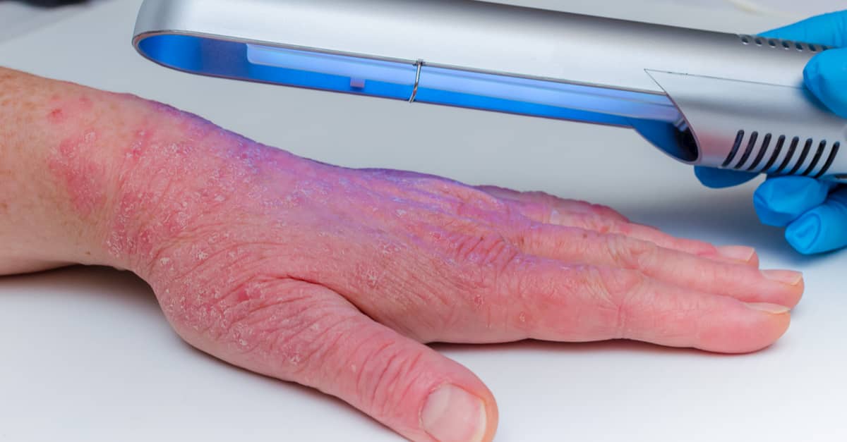 phototherapy-treatment