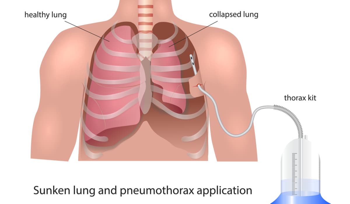 pneumothorax-treatment