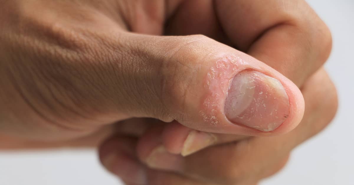 psoriasis-symptoms-on-a-nail