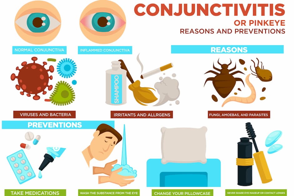 symptoms-of-viral-conjunctivitis