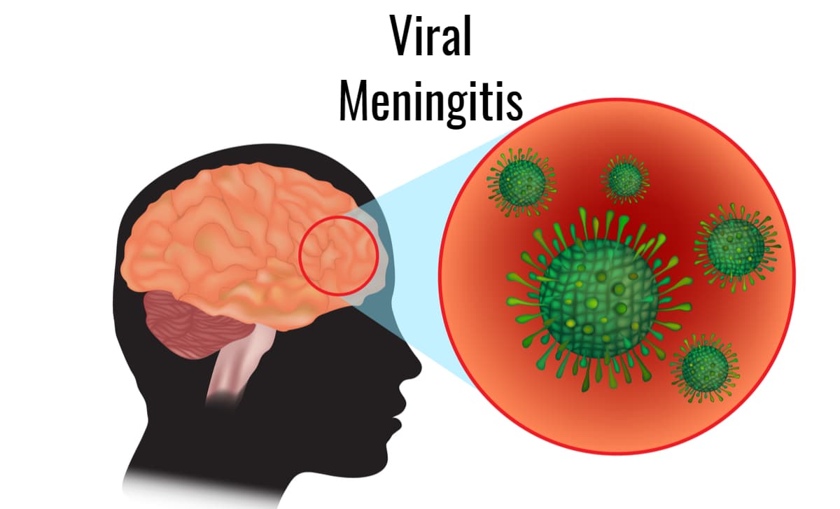 viral-meningitis