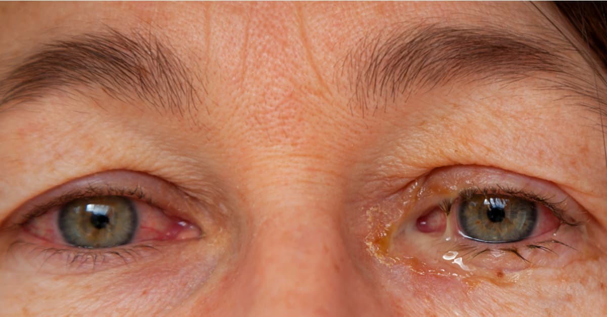 yellow-discharge-from-the-eye